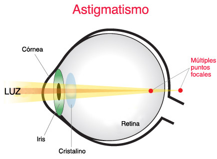 ojo_con_astigmatismo